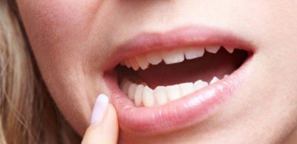 علامات تشير إلى الإصابة بسرطان الفم.. منها تخلخل الأسنان